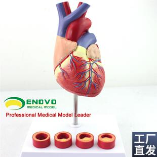 颐诺正品1:1医用人q体心脏模型动脉粥样硬化模型血栓心内科教学