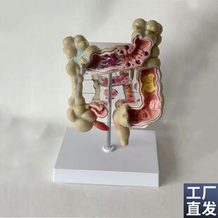 病理结肠模型盲肠阑尾肠扭u转梗阻消化道外科医药促销穿孔病变大