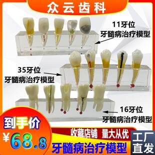 牙科口腔牙髓病治疗模型解剖前磨牙龋坏牙冠髓腔充填X可拆牙列模