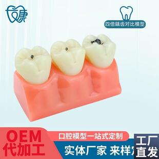 牙模型牙科口腔教学模型窝沟封闭模型龋齿R对比模型龋齿模型