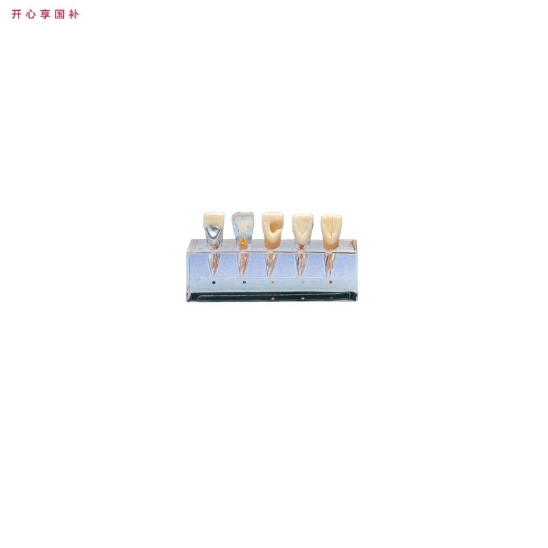 牙齿病变系i列模型B10015/1