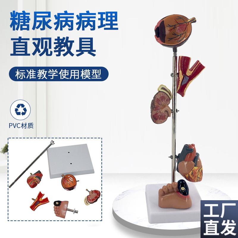 糖/尿病高/血压模型高血t压病理变脑眼心脏肾脏血管内脏模型G3