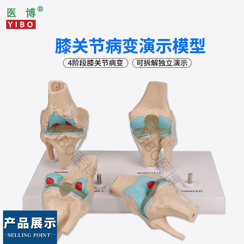 医博BIX-A3571膝关节病变模型 人体骨骼病变模型 人体膝关节4阶段