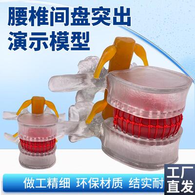 透明款腰椎放大腰椎间盘受压演示模型人体脊柱U病理椎间盘模型