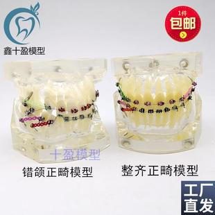 牙科正畸模型透明错颌矫正展x示模型结扎丝托槽正畸带支抗钉牙列