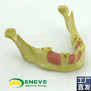 口腔种植齿科培训实训操作模型仿C真下颌骨人工种植缺失牙训练模