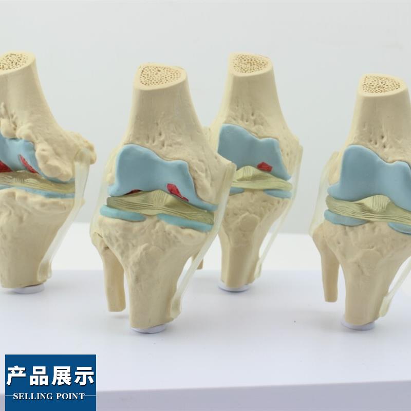 ENOVO颐诺人体病理膝关节模型 退行性血友病模型骨科管骨骼模型膝