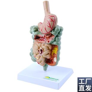 ENOVOc颐诺人体胃肠部疾病演示模型消化内科胃病肠道疾病展示医