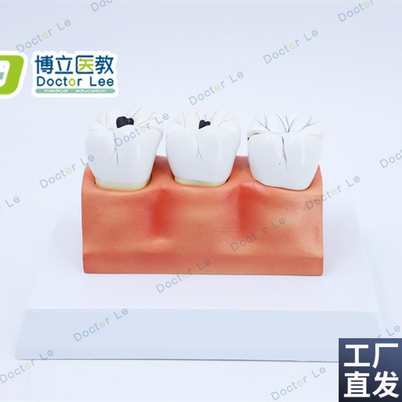 教学仿真龋齿模型牙n齿模型病变牙齿模型3颗龋齿模型龋齿分解模型