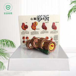 教学仿真血管模型活动血管阻塞模型血栓I病变标本4阶段性动脉O硬