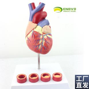 ENOVO颐诺1:1o医学人体心脏模型冠状动脉血栓心内科教学动脉粥样