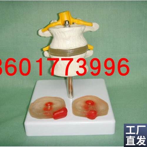 2节腰椎附2个病变椎间盘模型腰椎模型2节腰椎带腰X间盘病变模型
