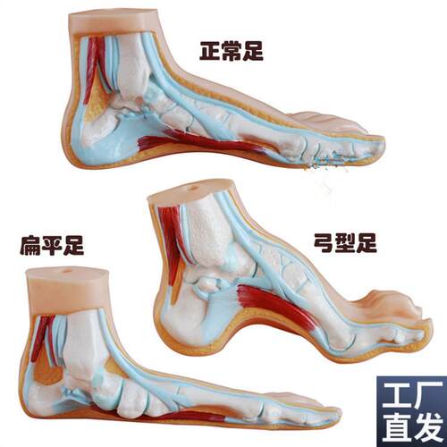 正常足扁平足弓形足o模型/足弓模型解剖模型脚模型教学模型