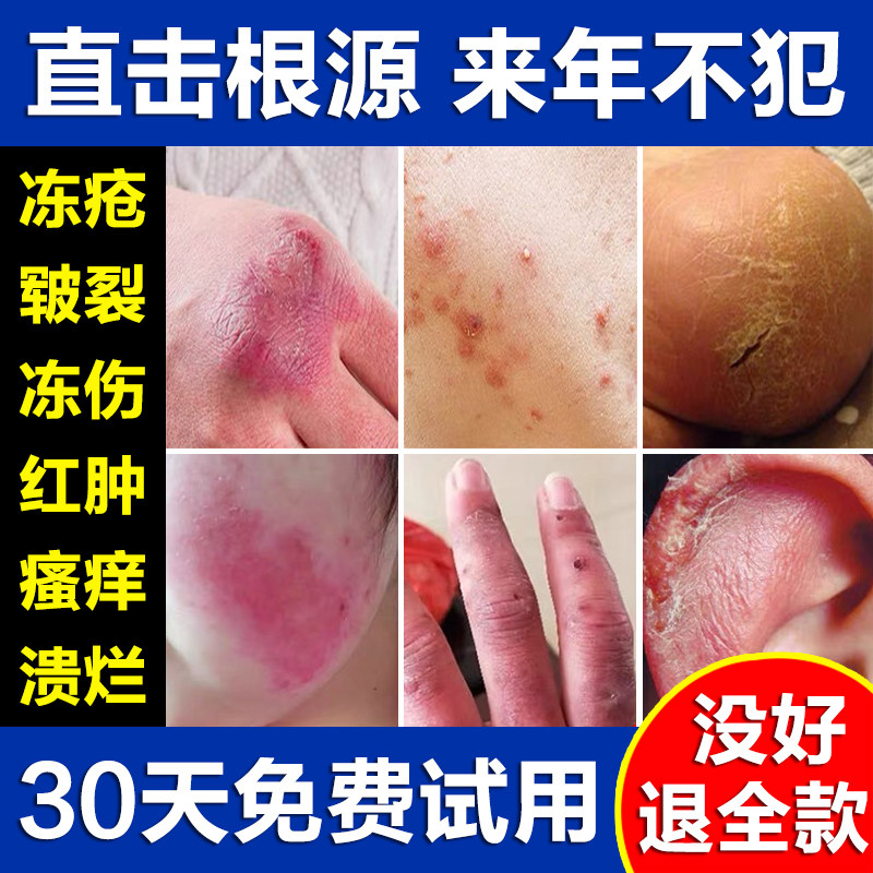 治冻膏疮止消痒肿水泡药去冻膏伤根特皲傚裂冰王鳄鱼红花蛇油日本