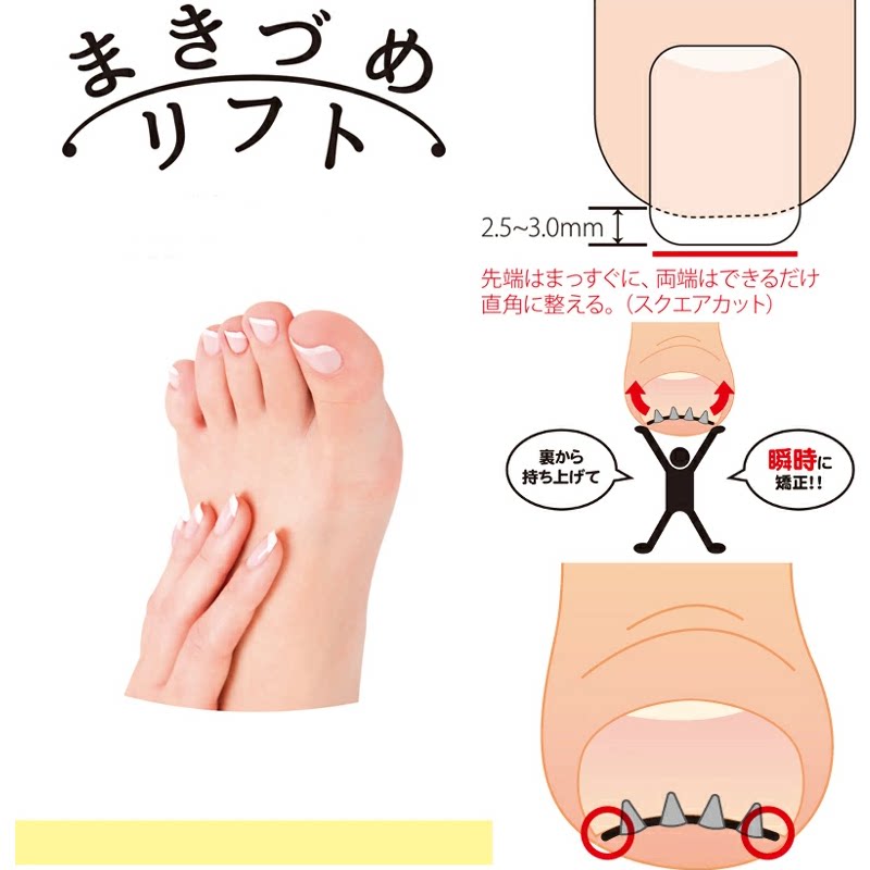 日本嵌甲矫正器正甲扣贴片甲沟脚趾炎甲指甲长肉里瞬间矫正护理贴