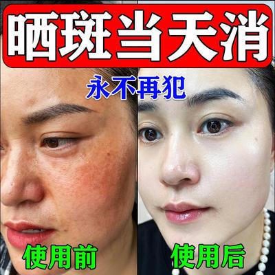 晒斑去除修复祛斑美白霜黄褐斑雀斑老年斑淡化黑色素沉淀专用药膏