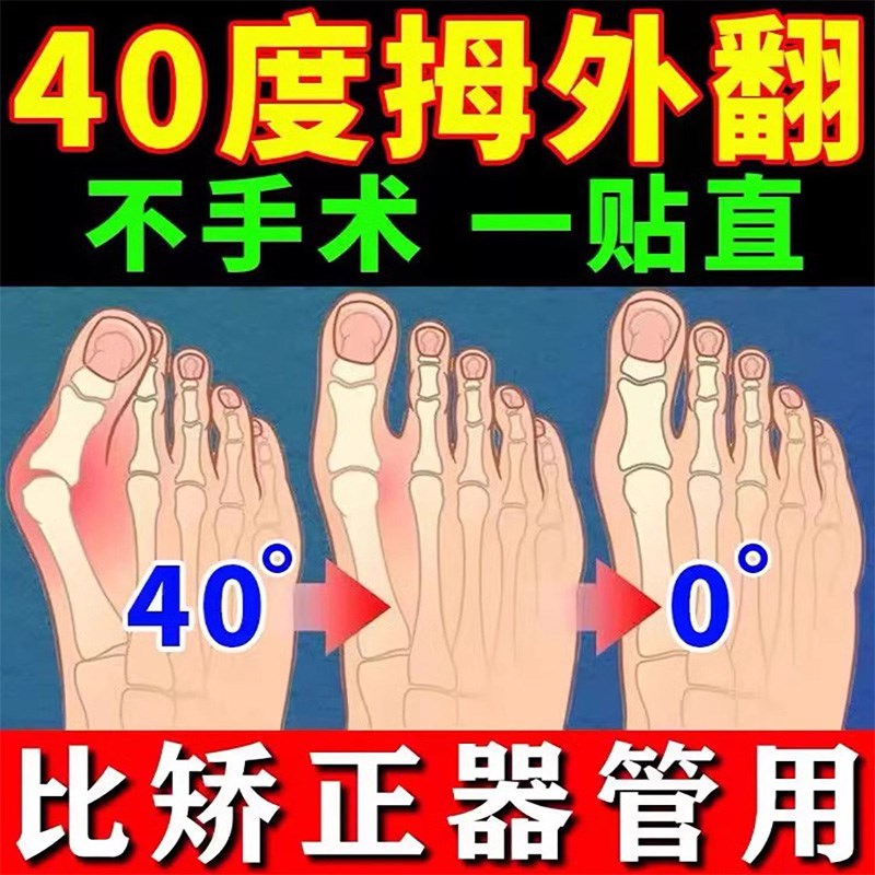 【三天消】拇指外翻贴大脚骨矫正神器脚趾重叠防磨脚趾变形疼痛贴