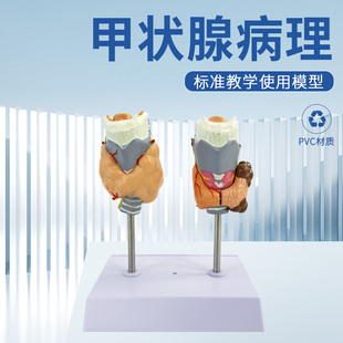 病理甲状腺模型 喉头解剖模型 甲状腺留 甲状线囊中 甲状线病