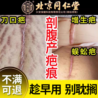 北京同仁堂剖腹产增生疤痕专用