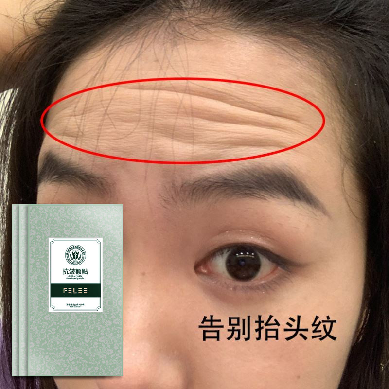 针对严重皱纹 额头纹 川字纹!