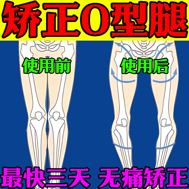 O型腿矫正神器小腿外翻矫正器改善X型腿罗圈腿内八腿专用贴矫正器