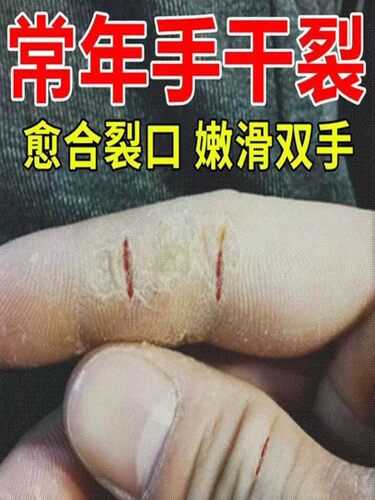 治手裂的药膏防干裂手脚上开裂脚后跟真菌感染手脱皮严重脱皮专用