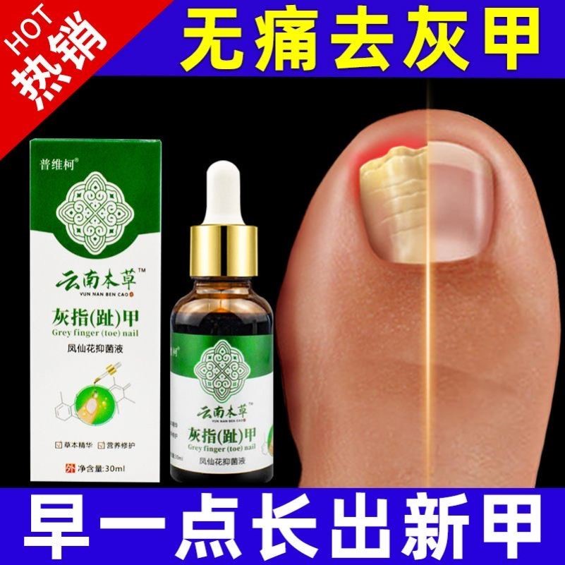 云南本草灰指甲抑菌液治疗专用膏草本黑指甲正品官方旗舰店
