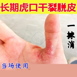 手干燥粗糙手裂的药膏手干裂脱皮真菌感染手指虎口开裂修复霜
