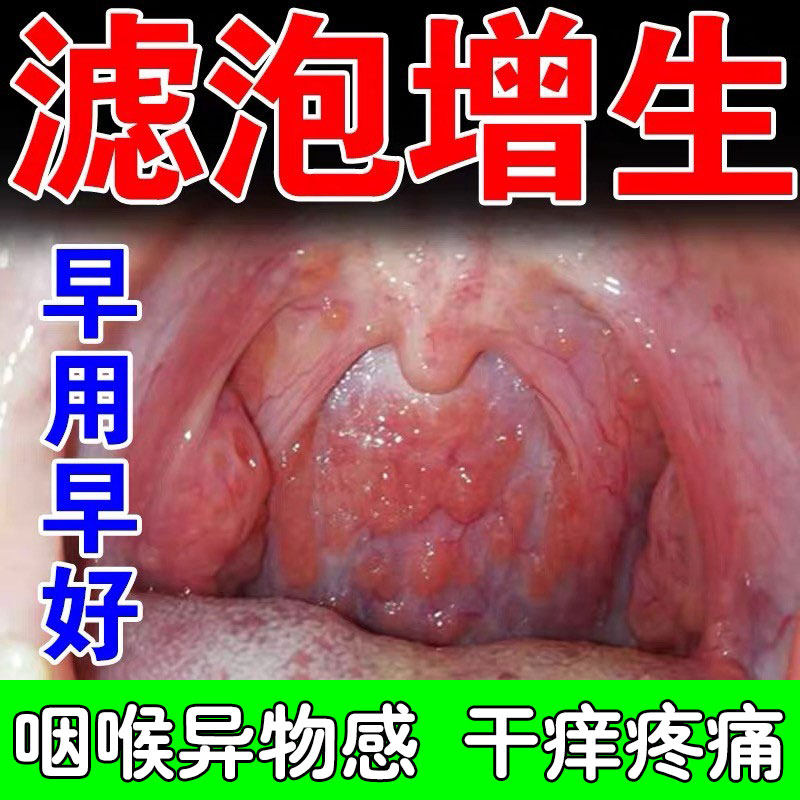 滤泡增生咽焱咽喉淋巴扁桃体肥大喉咙异物感嗓子疼药膏贴药膏神器