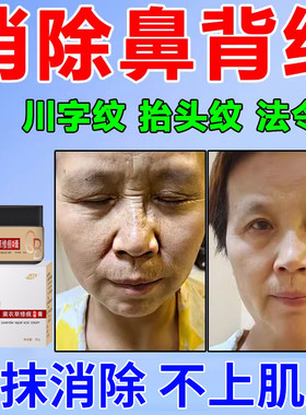 薰衣草修痕膏鼻背纹去除神器脸上眉间抬头横行皱纹肌肉修复贴面霜