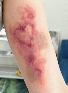 Heart Bruise Fake Tattoo for Woman Man Arm Art Scar Blood St