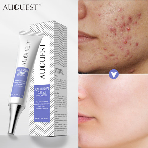 Herbal Acne Treatment Cream Pimple Spot Removal for Teens Oi