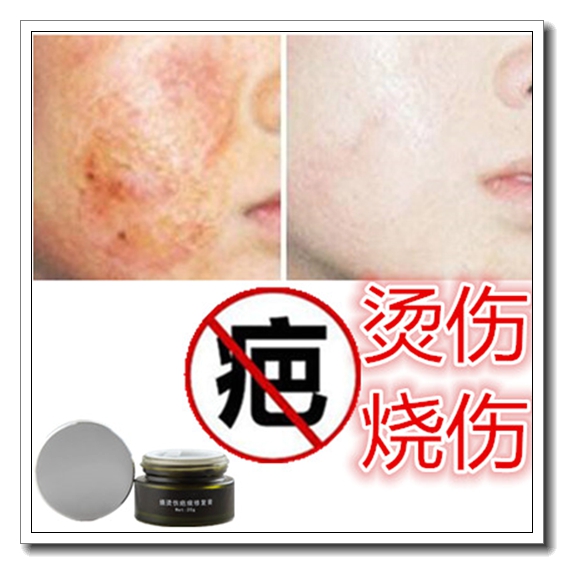 祛除手术男女增生性突疤疙瘩烧伤巴药软膏烟烫疤痕印正品淡化色素