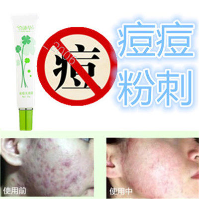祛除面部封闭合性暗疮豆豆液去前胸后背额头青春痘痘痕酒糟鼻正品