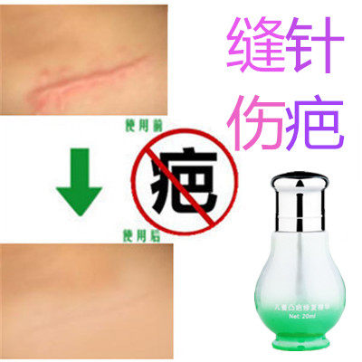 去剖宫产凸起手术疙瘩产后开刀割伤疤痕印除祛缝针冻疮色素印正品