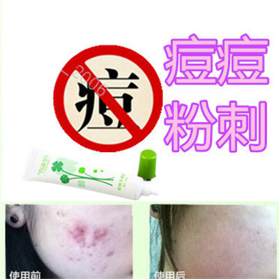 正品药用祛油性痘痕黑头痤疮平脂肪粒面疮前胸后背部酒刺痘痘全清