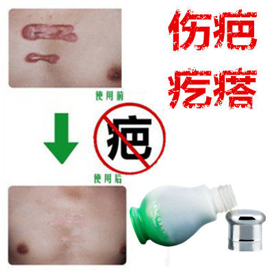 灵缝针修复剖宫产突起疙瘩破腹产刀伤巴痕烟疤手术抓伤摔伤撞伤疤