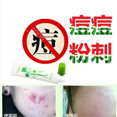 正品面疮酒刺去后背部痤疮平青春痘痘全清祛除胸前封闭合性痘痕液