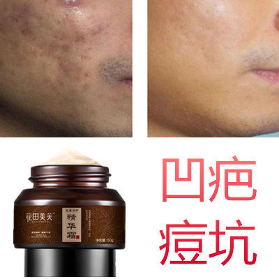 去凹洞祛脸部痘疤痘坑快速再生长精华霜男女毛孔粗大修复凹陷皮肤