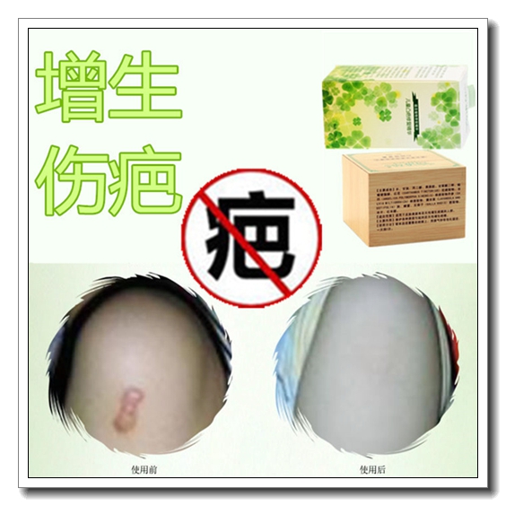 祛破腹产后伤口修复膏去除老刀巴灵美容贴淡化擦伤疤痕黑色素面膜