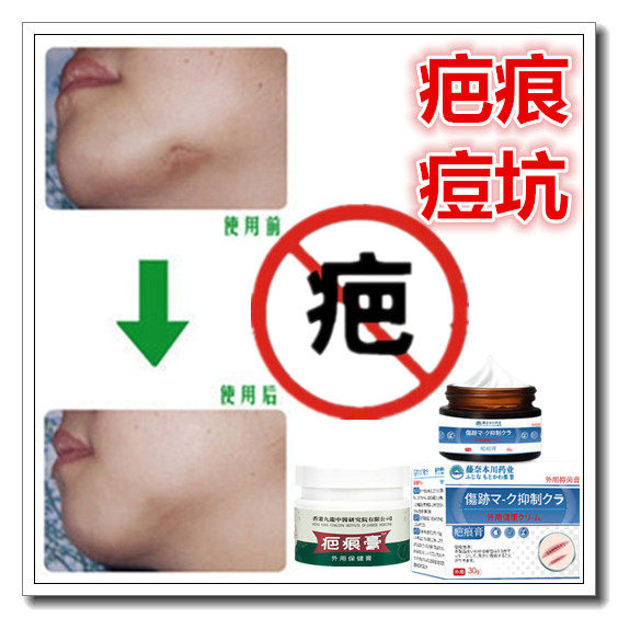 去色素手术产后增生修复冻疮疙瘩祛除缝针凹凸开伤疤痕印灵色素药