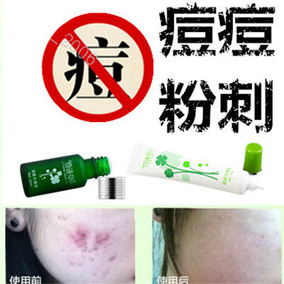 正品去除面部痘痘粉刺修复霜去前胸痤疮后背青春痘额头酒糟鼻精华