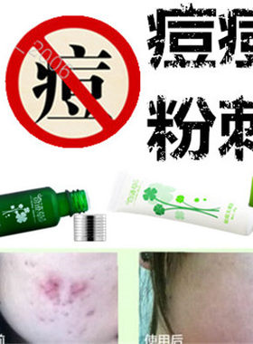正品去除面部痘痘粉刺修复霜去前胸痤疮后背青春痘额头酒糟鼻精华