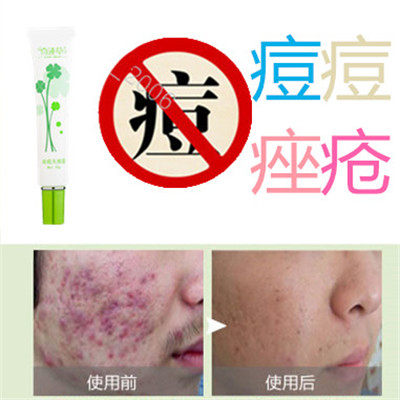 精华药用液去除后背部封闭合性痤疮平除痘痘立清消祛胸前豆豆痘痕