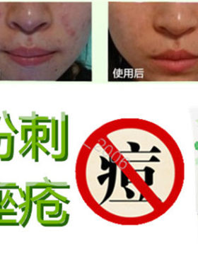 产品去除面部痤疮立消修复液祛青春痘全清防敏感痘痕平酒糟鼻黑头