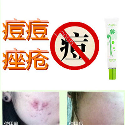 祛除后背部封闭合性暗疮痘痕男女药用液痘痘去胸前黑头痤疮修复霜
