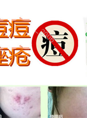 祛除后背部封闭合性暗疮痘痕男女药用液痘痘去胸前黑头痤疮修复霜