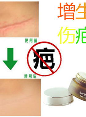除去疙瘩增生性突起祛缝针剖宫产刀伤疤痕纹身手术摔伤色素印药膏