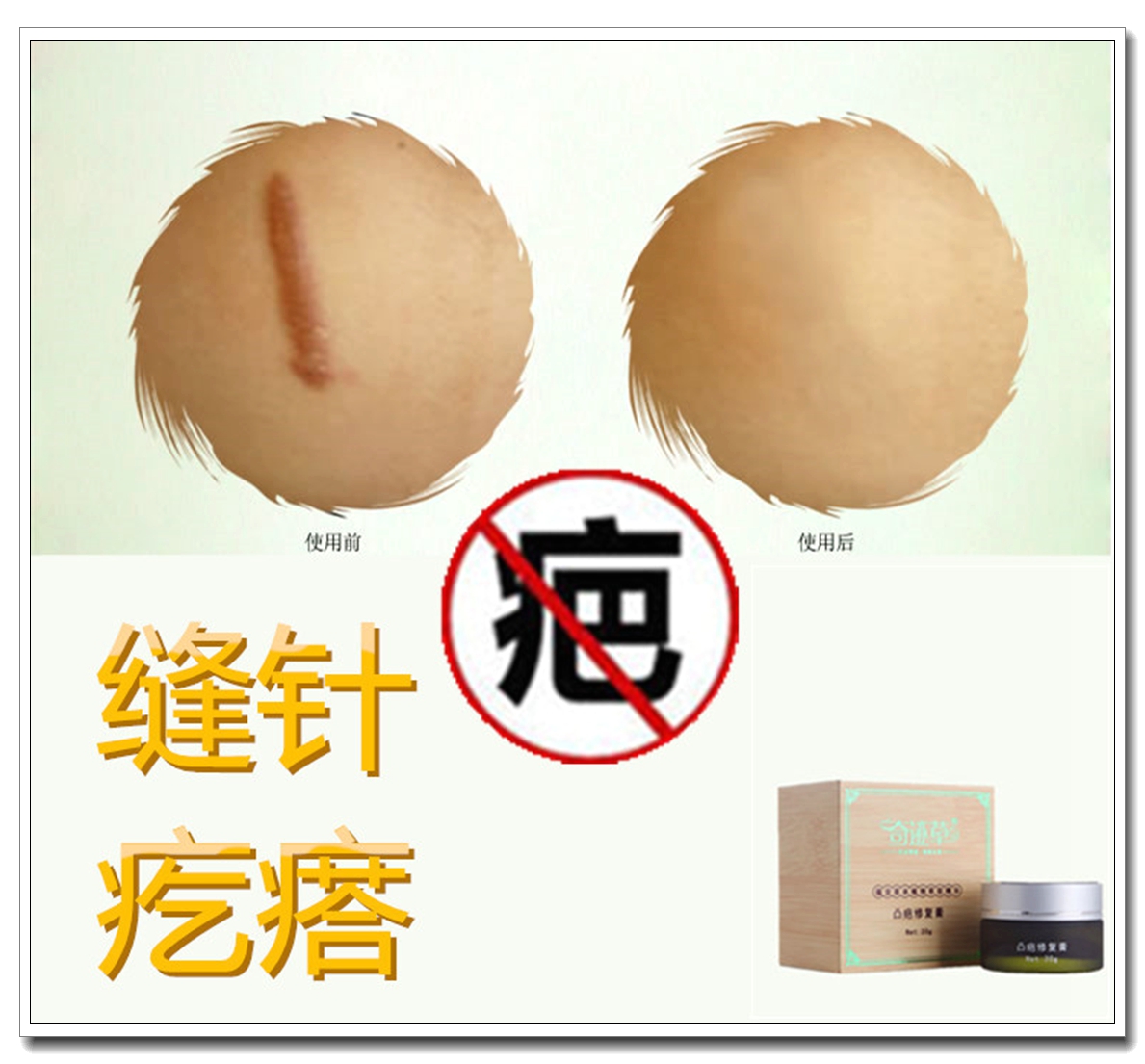 软化胸前增生祛除脸部凸起疙瘩去油烫伤巴膏修复脸部缝针疤痕膏贴