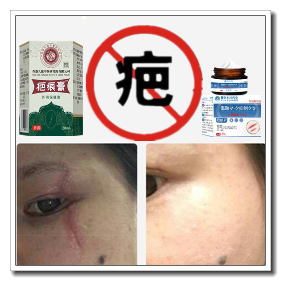 祛增生修复疙瘩性凸疤缝针剖宫产伤疤痕印激光手术抓伤色素沉着疤